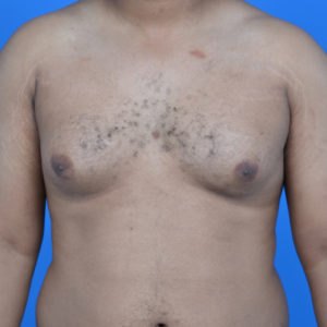 Gynecomastia before surgery front view case 951