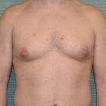 Gynecomastia before surgery front view case 958