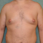 Gynecomastia before surgery front view case 965