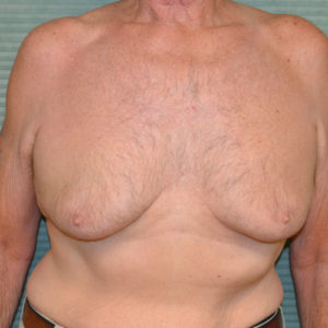 Before gynecomastia surgery front view case 972