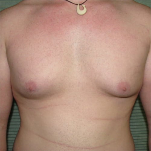 Before male breast reduction front view case 979