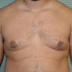 Before male breast reduction front view case 991
