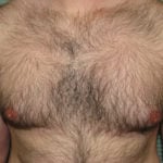 Before male breast reduction left profile case 999