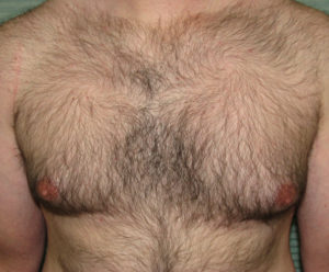 Before male breast reduction left profile case 999