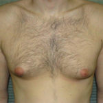 Before male breast reduction front view case 1004