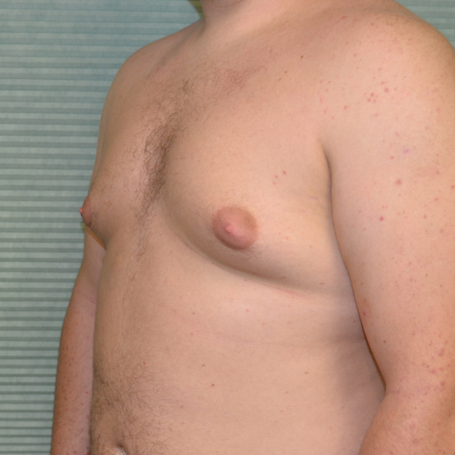 Gynecomastia after surgery front view case 965