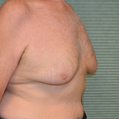 Before male breast reduction right oblique case 972
