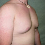 Before male breast reduction right oblique case 979