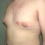 Before male breast reduction left oblique case 984