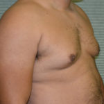 Before male breast reduction oblique view case 991