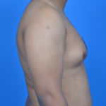 Gynecomastia before surgery right profile view case 951