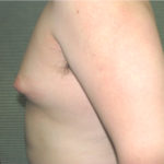 Before male breast reduction left profile case 984