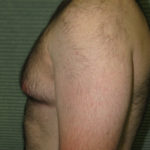 Before male breast reduction left profile view case 999