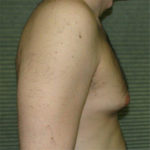 Before male breast reduction right profile view case 1004