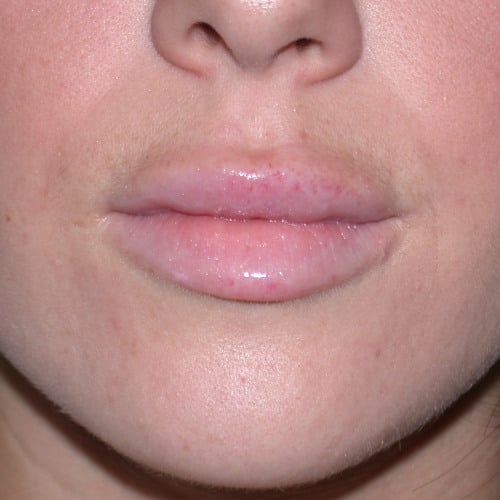 After restylane case 1017