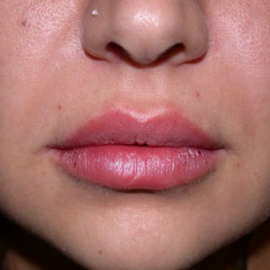 Lips after juvederm case 1020