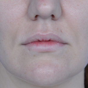 After lip augmentation case 1023