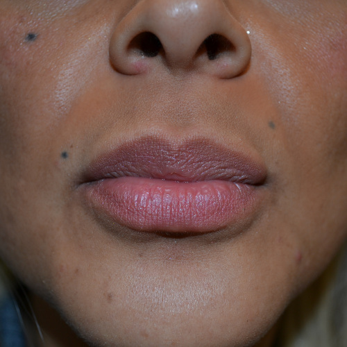 After lip augmentation case 1026