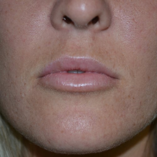 Closeup after lip augmentation case 1029