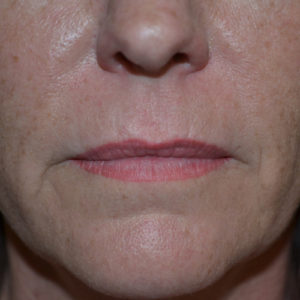 Lips before juvederm ultra case 1014