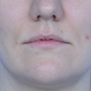 Before lip fillers case 1023
