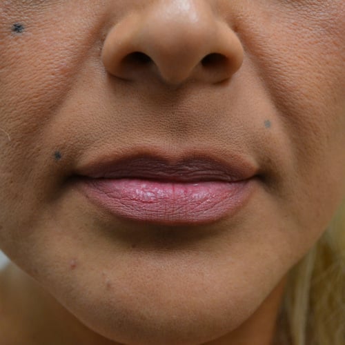 Before lip augmentation case 1026