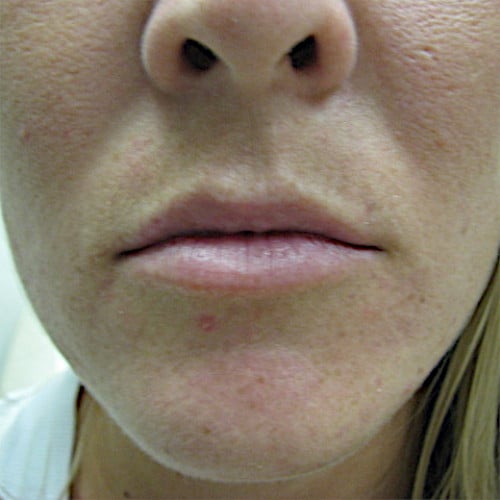 Closeup before lip augmentation case 1029
