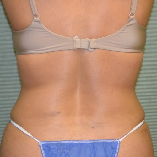 After liposuction, patient case 1648, back