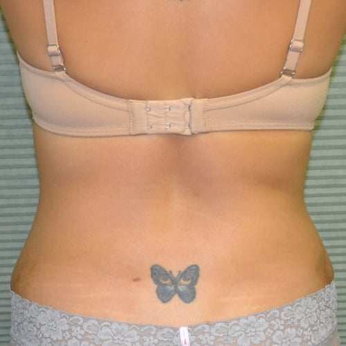 Back view of patient's flanks after lipo case 1228