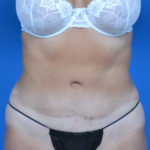 After liposuction front case 1657