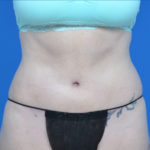 After liposuction on female patient's abdomen, case 1669