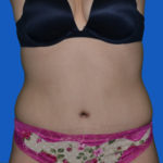 After liposuction to abdomen front view, case 1679