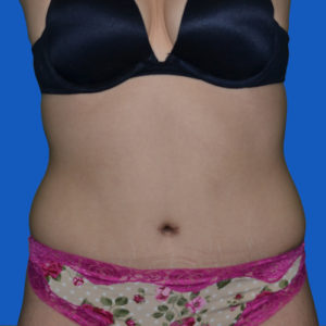 After liposuction to abdomen front view, case 1679
