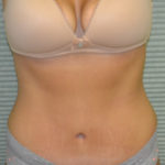 Front view of patient's midsection after liposuction