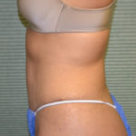 Left side view of patient after liposuction case 1648