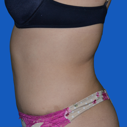 After liposuction to female patient, left side case 1679