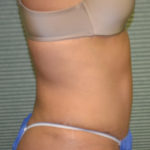 Right side view of patient's liposuction case 1648