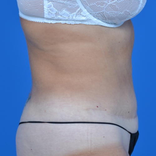 After liposuction right side case 1657