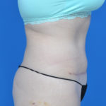 Right side view after liposuction on female patient's abdomen, case 1669