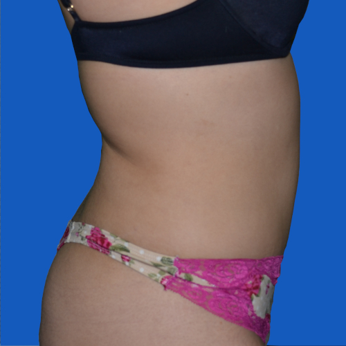 Female patient after lipo to abdomen, side view, case 1679