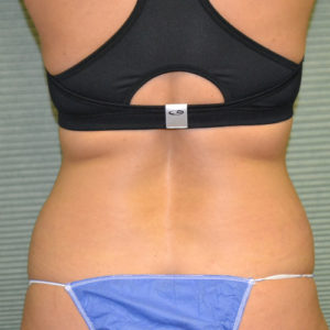Before liposuction on patient's flanks case 1648