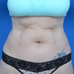 Before liposuction front view case 1669