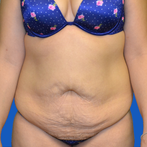 Female patient before lipo to abdomen case 1679
