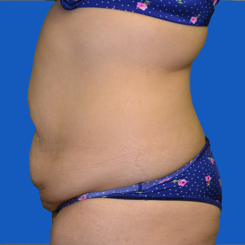 Before liposuction on female patient, left side, case 1679