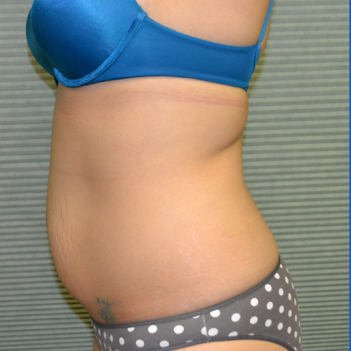 Left side of patient's midsection before liposuction