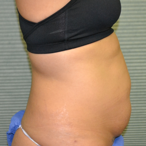 Before liposuction, patient case 1648, right side