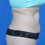 Before liposuction right side case 1669