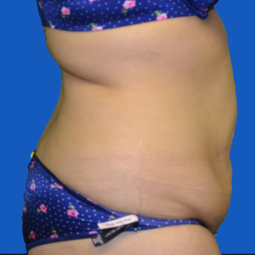 Before liposuction on female patient, right side, case 1679
