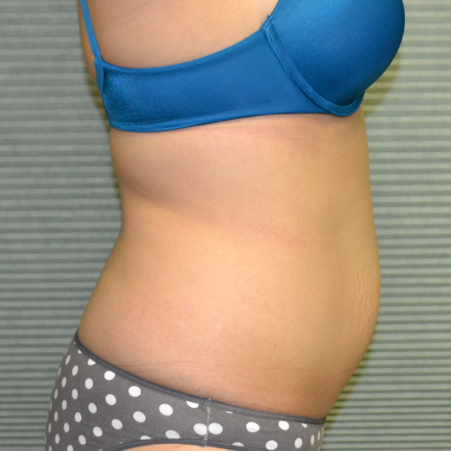 Right side of patient's midsection before liposuction
