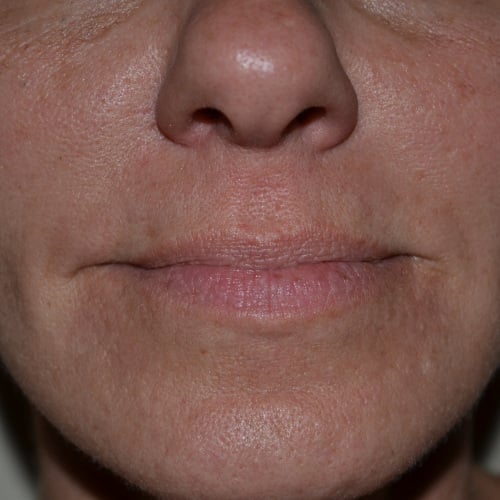 Nasolabial area closeup after fillers case 948